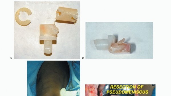 Illustration 88 for Advanced Distal Femoral Resections: Limb-Sparing Outcomes & Techniques