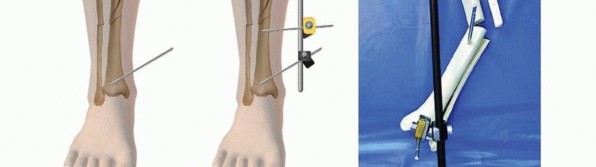 Illustration 27 for Tibia External Fixation: See How Pins Are Placed for Healing