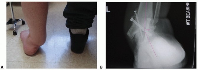Illustration 6 for Unlock Stability: Medullary Nail Fixation for Tibiotalocalcaneal Arthrodesis
