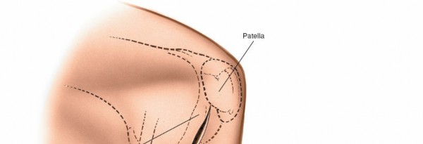 Illustration 136 for Mastering Knee Approaches: Spotlight on Superficial Medial Ligament