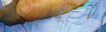 Illustration 56 for Unlock the Figure Posterior Approach to the Hip