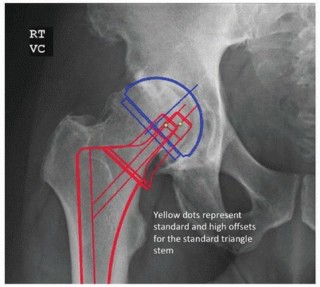 Illustration 3 for Extensively Porouscoated Stems: Proven Success & Superior Fixation