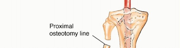 Illustration 3 for Free Vascularized Fibular Grafts: Solving Complex Bone Defects