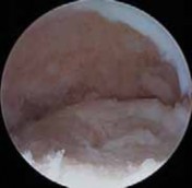 Illustration 41 for Precision Arthroscopy for Chondral Injuries & OCD: Direct Lateral Portal