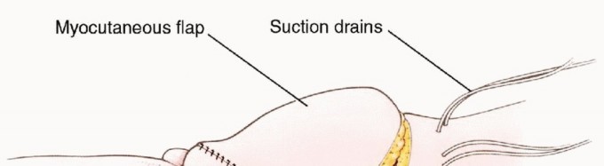 Illustration 38 for Anterior Flap Hemipelvectomy: Leveraging fig tech fig for Difficult Tumors