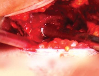 Illustration 9 for Mastering the Anterolateral Approach in Minimally Invasive Hip Replacement