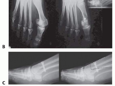 Illustration 32 for Mastering the Biplanar Distal Chevron for Effective Bunion Surgery
