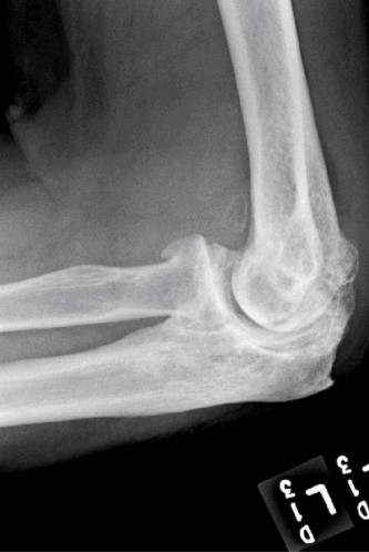 Elbow Osteoarthritis: Comprehensive Guide to Epidemiology, Anatomy & Clinical Insights