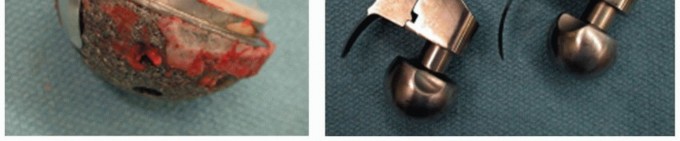 Illustration 8 for Mastering Component Removal: Extended Trochanteric Osteotomy