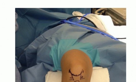 Illustration 9 for Treating Tibial Spine Fractures: Arthroscopy or Open Reduction?