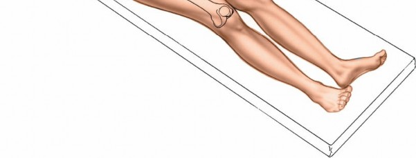 Illustration 27 for Optimal Femoral Approaches: Mastering the Lateral Intermuscular Septum