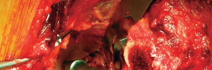 Illustration 35 for Cemented Component Longevity: The Critical Margin of the Acetabulum