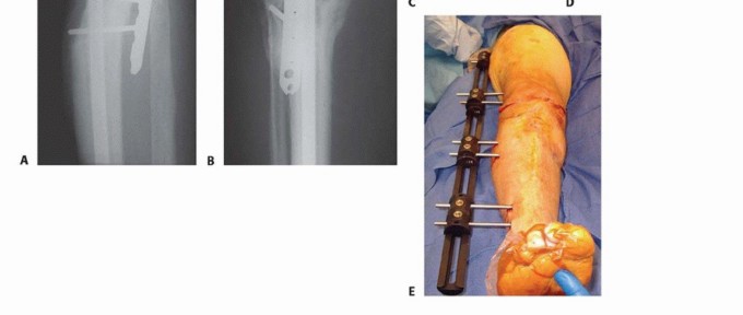 Illustration 14 for Knee Arthrodesis: A Solution for Stable Femur & Tibia Fusion