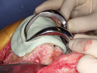 Illustration 31 for PROSTALAC Articulating Spacer: Treat Infected Knees, Regain Mobility