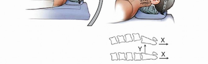 Illustration 4 for Master Techniques for Cervical Fracture Reduction: Type III & More