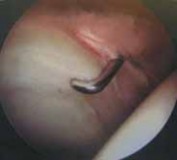 Illustration 10 for Resolving Femoral Head Neck Impingement: Arthroscopic FAI Solutions