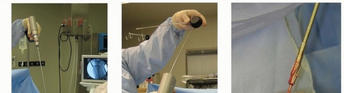 Illustration 38 for Advanced Nailing of the Mature Tibia: Overcoming Complexities