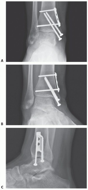 Illustration 36 for Painful Talus Lesions? The tech fig c Osteochondral Transfer Solution