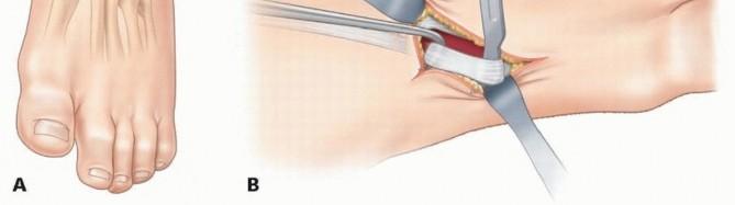 Illustration 11 for Why Anterior Tibialis Muscle Transfer Fixes Clubfoot