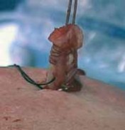 Illustration 18 for Arthroscopic Subscapularis Repair: The lo iky brady Method for Stability