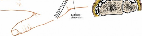 Illustration 22 for Essential Surgical Approaches: Uncover Every Aspect of the Wrist