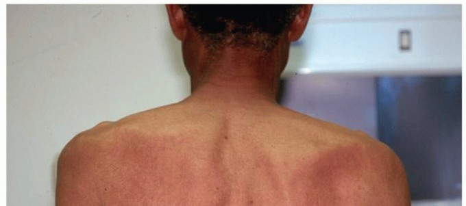 Illustration 4 for Decompressing the Transverse Scapular Ligament for Shoulder Pain Relief