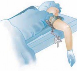 Illustration 9 for Precision Arthroscopy for Chondral Injuries & OCD: Direct Lateral Portal