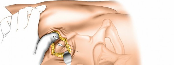 Illustration 18 for Key Approaches for External Fixation: Humerus, Radius, Ulna, Wrist