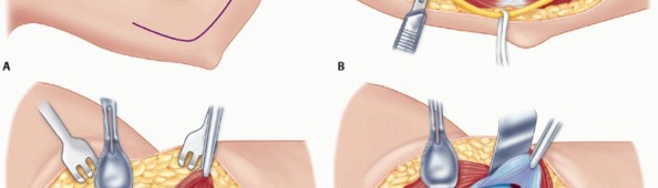 Illustration 55 for Surgical Approaches to Shoulder & Elbow: Pearls and Pitfalls