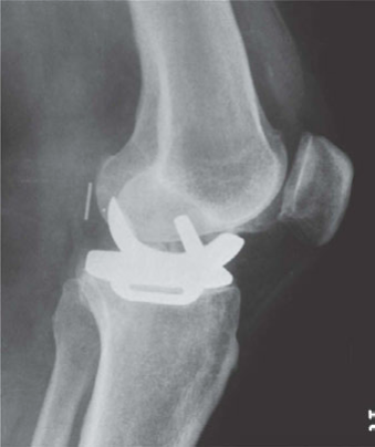 Illustration 4 for Oral Examination Question: Master Unicondylar UKA vs HTO