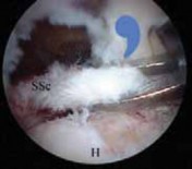 Illustration 32 for Arthroscopic Subscapularis Repair: The lo iky brady Method for Stability