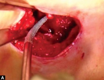 Illustration 18 for Mastering the Anterolateral Approach in Minimally Invasive Hip Replacement