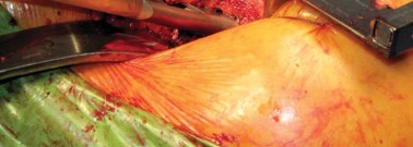 Illustration 33 for Kinectiv® Stem: Modular Necks for Primary THA Success