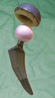 Illustration 3 for Unlock better THA: The technique of short stem for less invasiveness