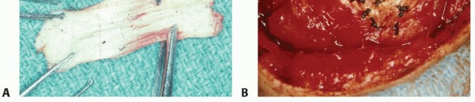 Illustration 18 for Subscapularis & Teres Rotator Cuff Repair: Advanced Techniques