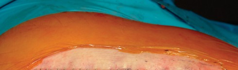 Illustration 70 for Direct Lateral Hip: Optimize Exposure with Sharp Curved Hohmann