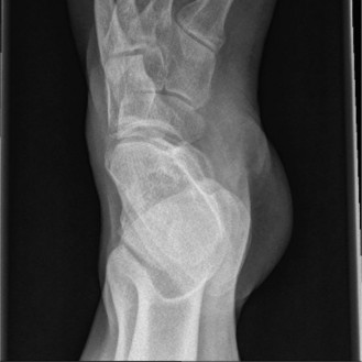 Illustration 3 for Foot & Ankle Cases: When to Consider a Strong Anterior Tibialis
