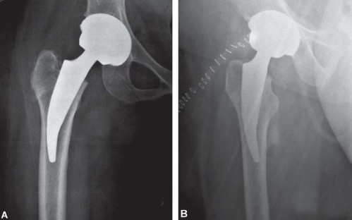 Illustration 37 for Considering METHA Short Stem? Discover Bone-Preserving THA