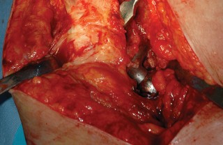 Illustration 78 for Femoral Stem Revision: Posterior Approach for Better Outcomes