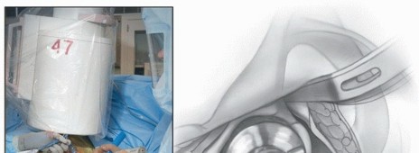 صورة طبية: النهج الأمامي لاستبدال مفصل الورك الكلي: ثورة في جراحة الورك مع الأستاذ الدكتور محمد هطيف في صنعاء