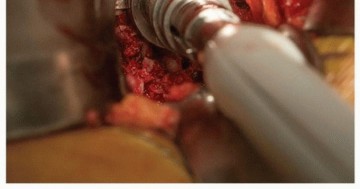 Illustration 7 for Mastering The Uncemented Socket: Ensure Lasting Hip Fixation