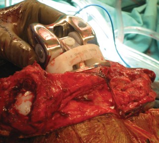 Illustration 56 for Hinged Total Knee: The Salvage Solution for Challenging Cases