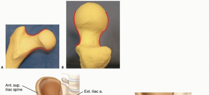 Illustration 5 for Is a Sliding Hip Screw Best for Your Femoral Neck Fracture?