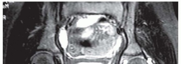 Illustration 5 for Labral Support Shelf Procedure: Preventing Perthes Deformity