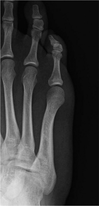 Bunionette or Fifth Metatarsal Head Pain: What's the Fix?