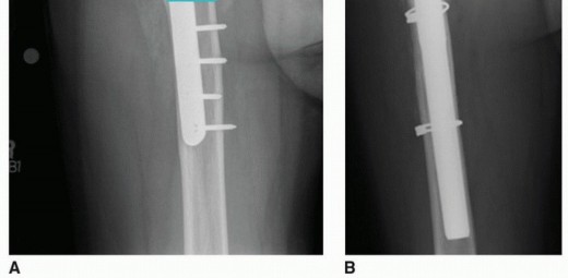 Illustration 14 for Overcoming Proximal Femoral Deformity in THA: Key Strategies