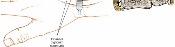 Illustration 23 for Dorsal Wrist Approach: Expert Access to the Column of the Distal Radius