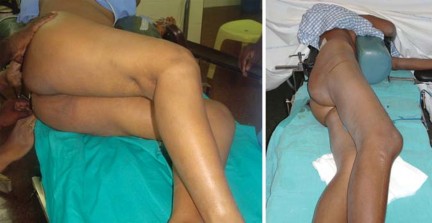 Illustration 14 for Total Hip Arthroplasty: Restoring Mobility in Juvenile Idiopathic Arthritis