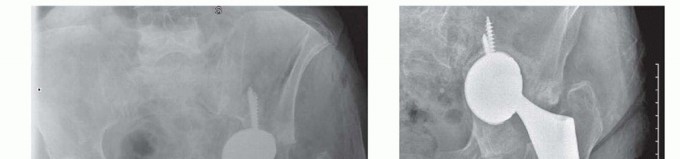 Illustration 17 for Total Hip Arthroplasty: Journey to Preventing Complications