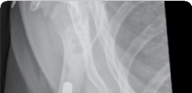 Radial Head Replacement: Solutions for Complex Elbow Injuries
